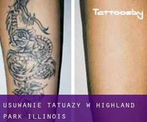 Usuwanie tatuaży w Highland Park (Illinois)
