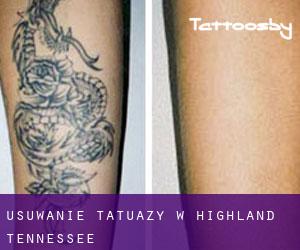 Usuwanie tatuaży w Highland (Tennessee)