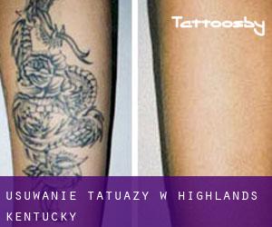 Usuwanie tatuaży w Highlands (Kentucky)