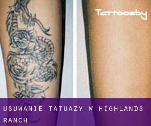 Usuwanie tatuaży w Highlands Ranch