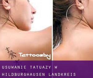 Usuwanie tatuaży w Hildburghausen Landkreis