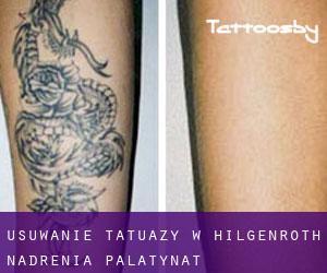 Usuwanie tatuaży w Hilgenroth (Nadrenia-Palatynat)