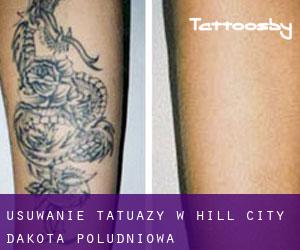Usuwanie tatuaży w Hill City (Dakota Południowa)