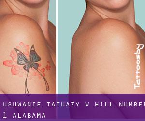 Usuwanie tatuaży w Hill Number 1 (Alabama)