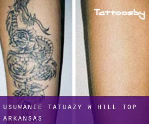 Usuwanie tatuaży w Hill Top (Arkansas)