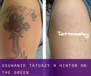 Usuwanie tatuaży w Hinton on the Green