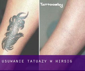 Usuwanie tatuaży w Hirsig