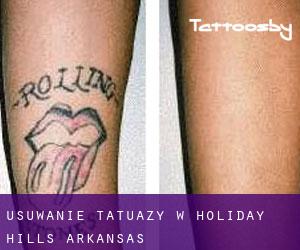 Usuwanie tatuaży w Holiday Hills (Arkansas)