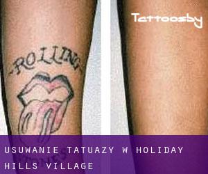 Usuwanie tatuaży w Holiday Hills Village