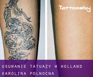 Usuwanie tatuaży w Holland (Karolina Północna)