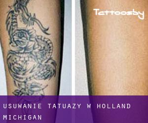 Usuwanie tatuaży w Holland (Michigan)