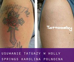 Usuwanie tatuaży w Holly Springs (Karolina Północna)