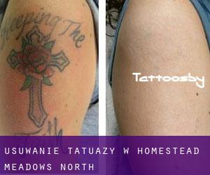 Usuwanie tatuaży w Homestead Meadows North