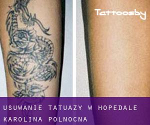Usuwanie tatuaży w Hopedale (Karolina Północna)