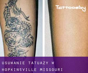 Usuwanie tatuaży w Hopkinsville (Missouri)