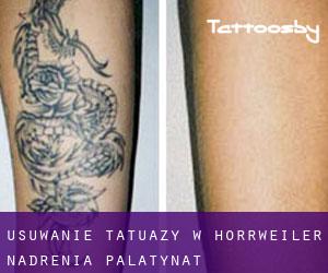 Usuwanie tatuaży w Horrweiler (Nadrenia-Palatynat)