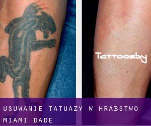Usuwanie tatuaży w Hrabstwo Miami-Dade