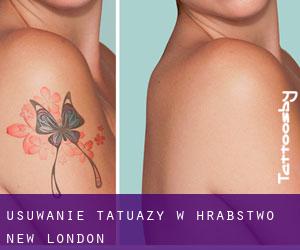 Usuwanie tatuaży w Hrabstwo New London