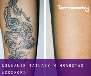 Usuwanie tatuaży w Hrabstwo Woodford
