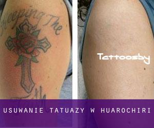 Usuwanie tatuaży w Huarochirí