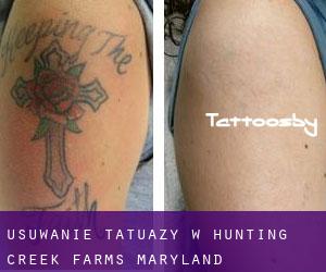 Usuwanie tatuaży w Hunting Creek Farms (Maryland)