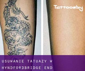 Usuwanie tatuaży w Hyndfordbridge-end