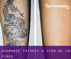 Usuwanie tatuaży w Icod de los Vinos
