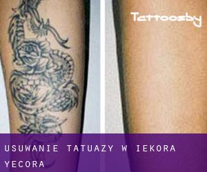 Usuwanie tatuaży w Iekora / Yécora