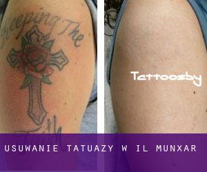 Usuwanie tatuaży w Il-Munxar