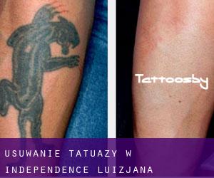 Usuwanie tatuaży w Independence (Luizjana)