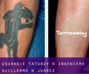 Usuwanie tatuaży w Ingeniero Guillermo N. Juárez