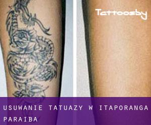 Usuwanie tatuaży w Itaporanga (Paraíba)