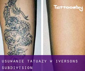 Usuwanie tatuaży w Iversons Subdivision