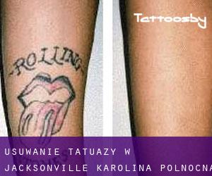 Usuwanie tatuaży w Jacksonville (Karolina Północna)