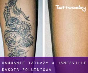 Usuwanie tatuaży w Jamesville (Dakota Południowa)