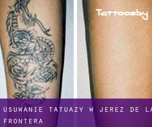 Usuwanie tatuaży w Jerez de la Frontera