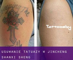 Usuwanie tatuaży w Jincheng (Shanxi Sheng)