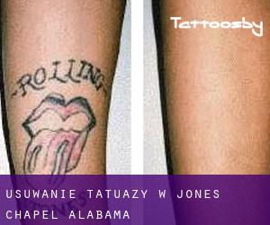 Usuwanie tatuaży w Jones Chapel (Alabama)