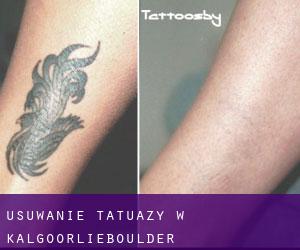 Usuwanie tatuaży w Kalgoorlie/Boulder