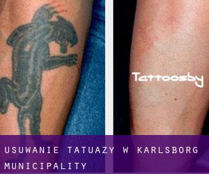 Usuwanie tatuaży w Karlsborg Municipality