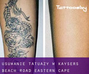 Usuwanie tatuaży w Kayser's Beach Road (Eastern Cape)