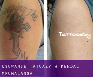 Usuwanie tatuaży w Kendal (Mpumalanga)