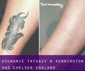 Usuwanie tatuaży w Kennington and Chelsea (England)