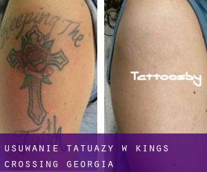 Usuwanie tatuaży w Kings Crossing (Georgia)