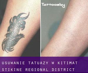 Usuwanie tatuaży w Kitimat-Stikine Regional District