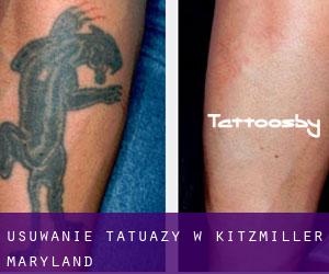 Usuwanie tatuaży w Kitzmiller (Maryland)