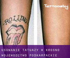 Usuwanie tatuaży w Krosno (Województwo podkarpackie)