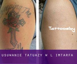 Usuwanie tatuaży w L-Imtarfa