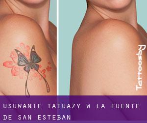 Usuwanie tatuaży w La Fuente de San Esteban
