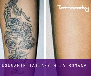 Usuwanie tatuaży w La Romana